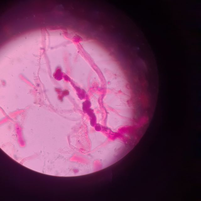 Mikroskopi av urin til en pasient med glomerulonefritt (betennelse i nyren)